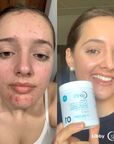Extra Strength Acne Control Vitamins - choose from 2 pack sizes