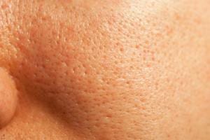 Tightening Enlarged Pores