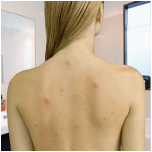 Say Goodbye to Back Acne Scars Forever Proven Tactics & Myths Busted