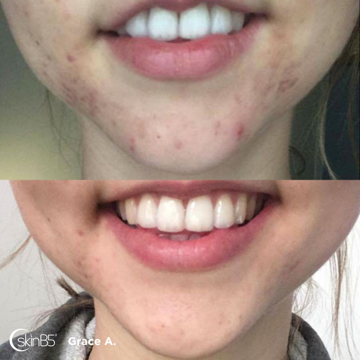 SkinB5™ completely changed Grace Armstrong skin in 2 months