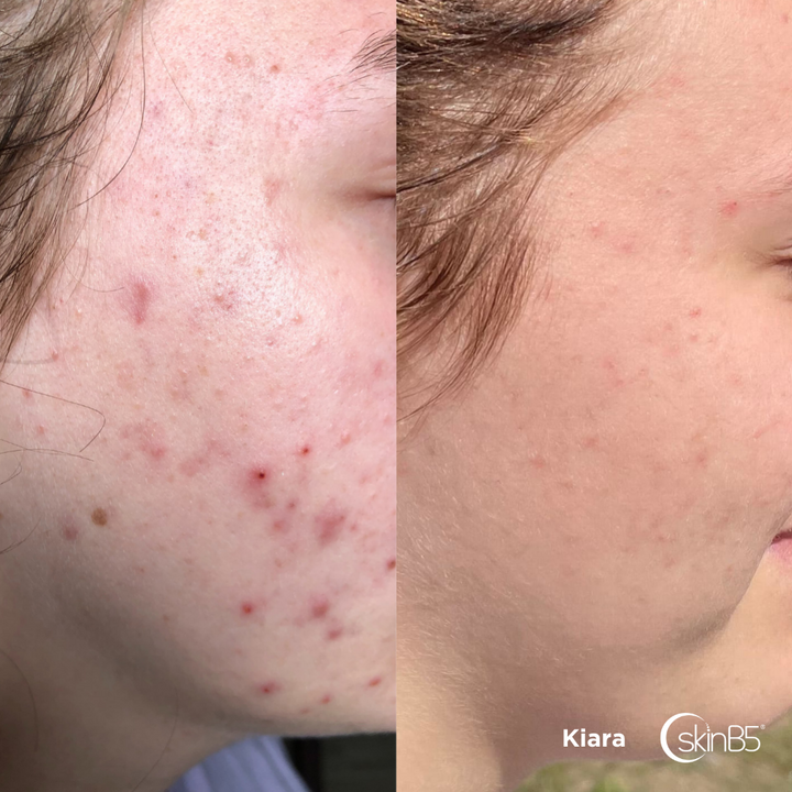 Kiara noticed her skin has changed in ONE week