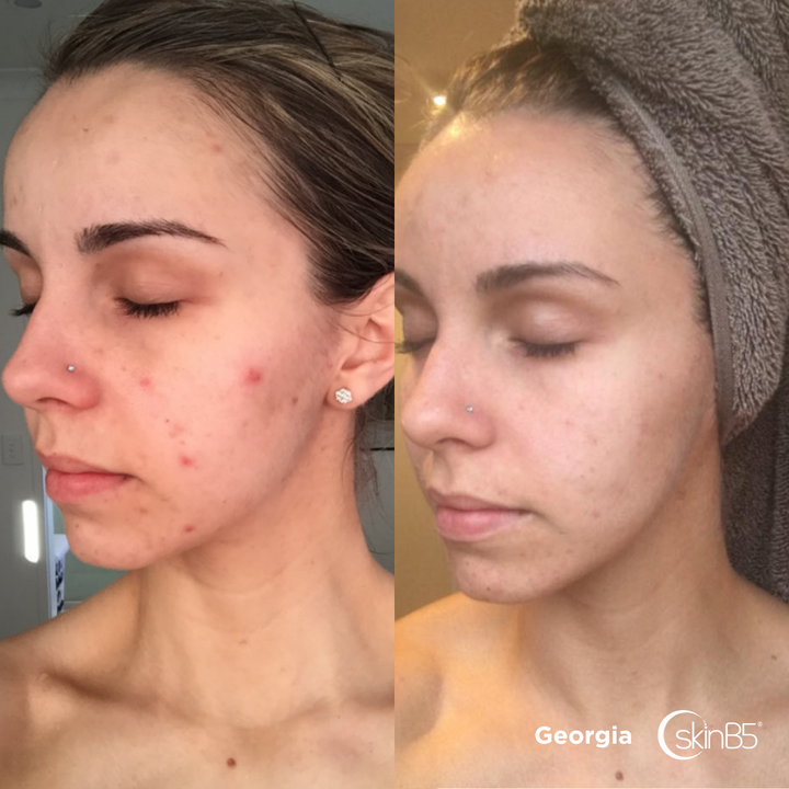 Georgia regained smooth and healthy skin by using the skinB5™ range