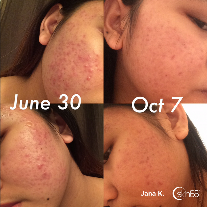 Learn how Jana Karylle overcome severe acne with skinB5™