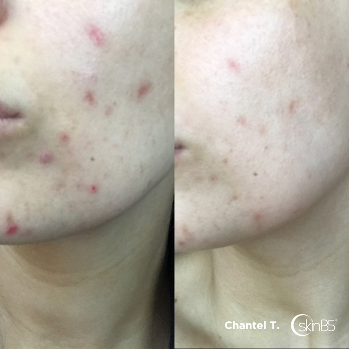 Chantel Thompson noticed her skin has huge difference in 4 weeks