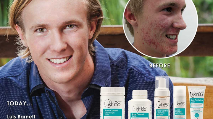 Podcast - Controlling Acne From The Inside Out With SkinB5 founder Judy Cheung-Wood