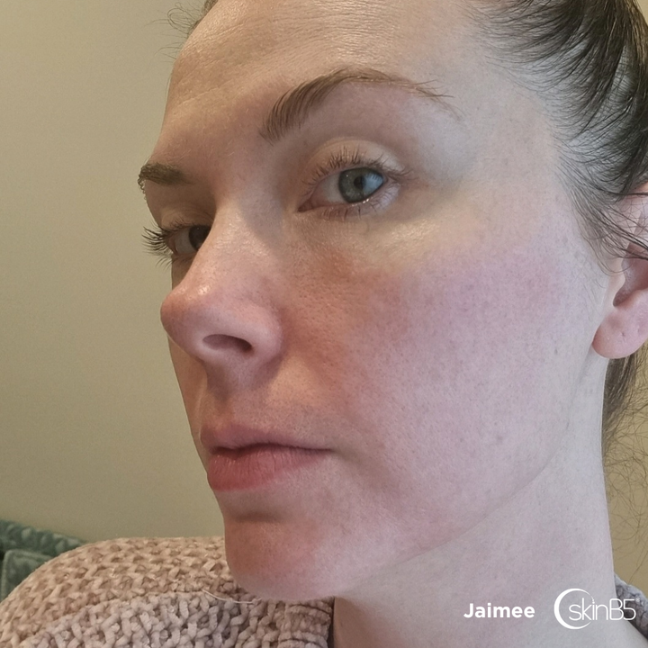 SkinB5™ helped Jaimee Completely cleared up her acne in 2 weeks