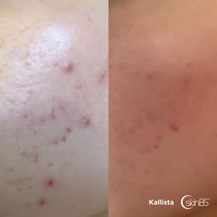 Kallista's skin has massively improved in One Month