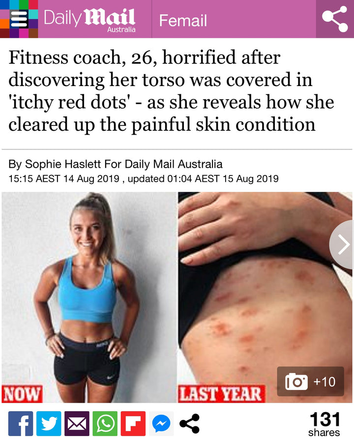 Daily Mail article - SkinB5 case study psoriasis