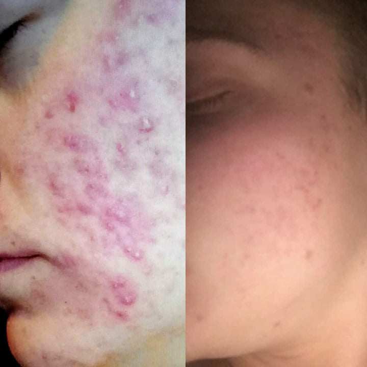 How Kaysie Ryan overcome severe adult acne