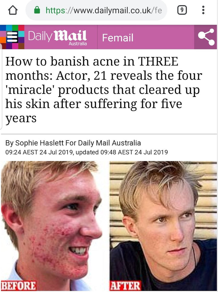 Daily Mail article - SkinB5 case study severe acne