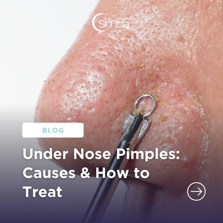 Under Nose Pimples: Causes & How to Treat