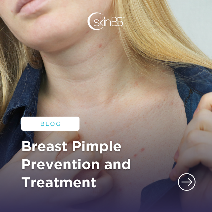 Breast Pimple Prevention and Treatment