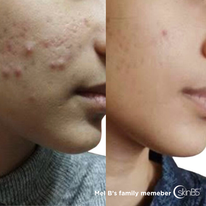 SkinB5™ Helped Mel B's Family Member to regain clear skin