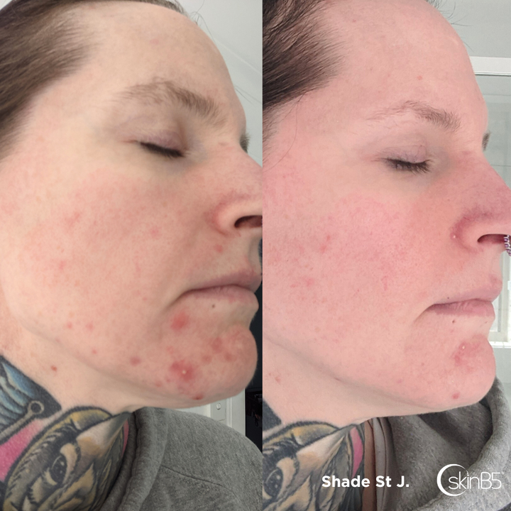 Shade St Jude Regained Her Perfect Skin with SkinB5™ Products