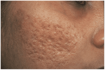 Tips on How to Prevent Acne Scarring