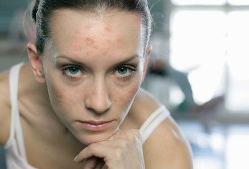 Adult Acne in Women