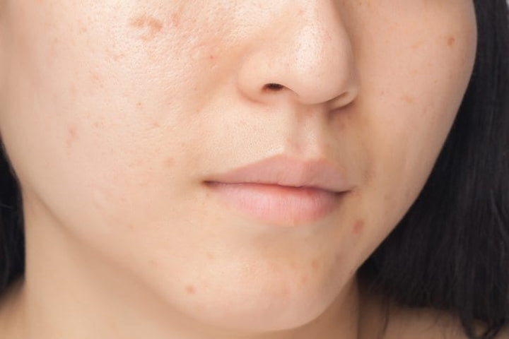 Repairing Acne Scars