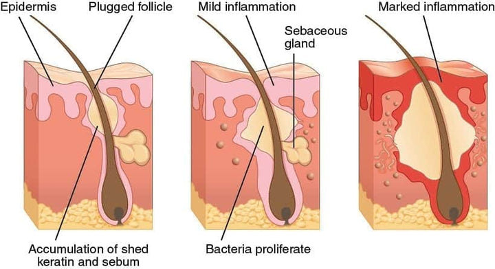 4 Ways to Treat Clogged Pores to Improve Acne and Health