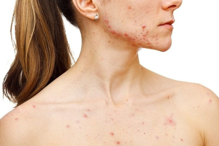 Mature Age Acne: What to do When You’ve Tried it All